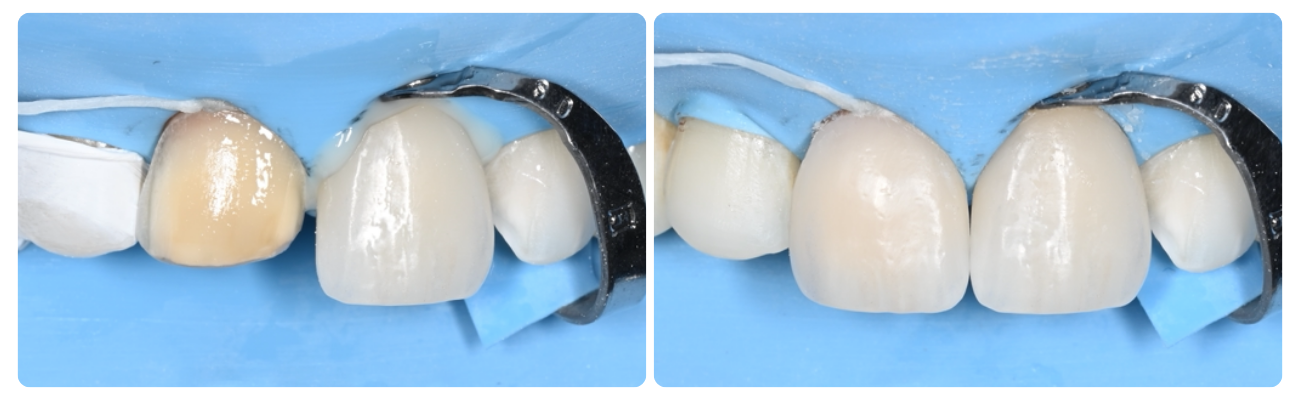 Definitieve Plaatsing - Keramische Restauraties